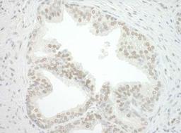 Immunohistochemistry: CBX7 Antibody [NBP1-40343] - FFPE section of human prostate carcinoma.  Antibody used at a dilution of 1:250 Detection: DAB staining using Immunohistochemistry Accessory Kit.