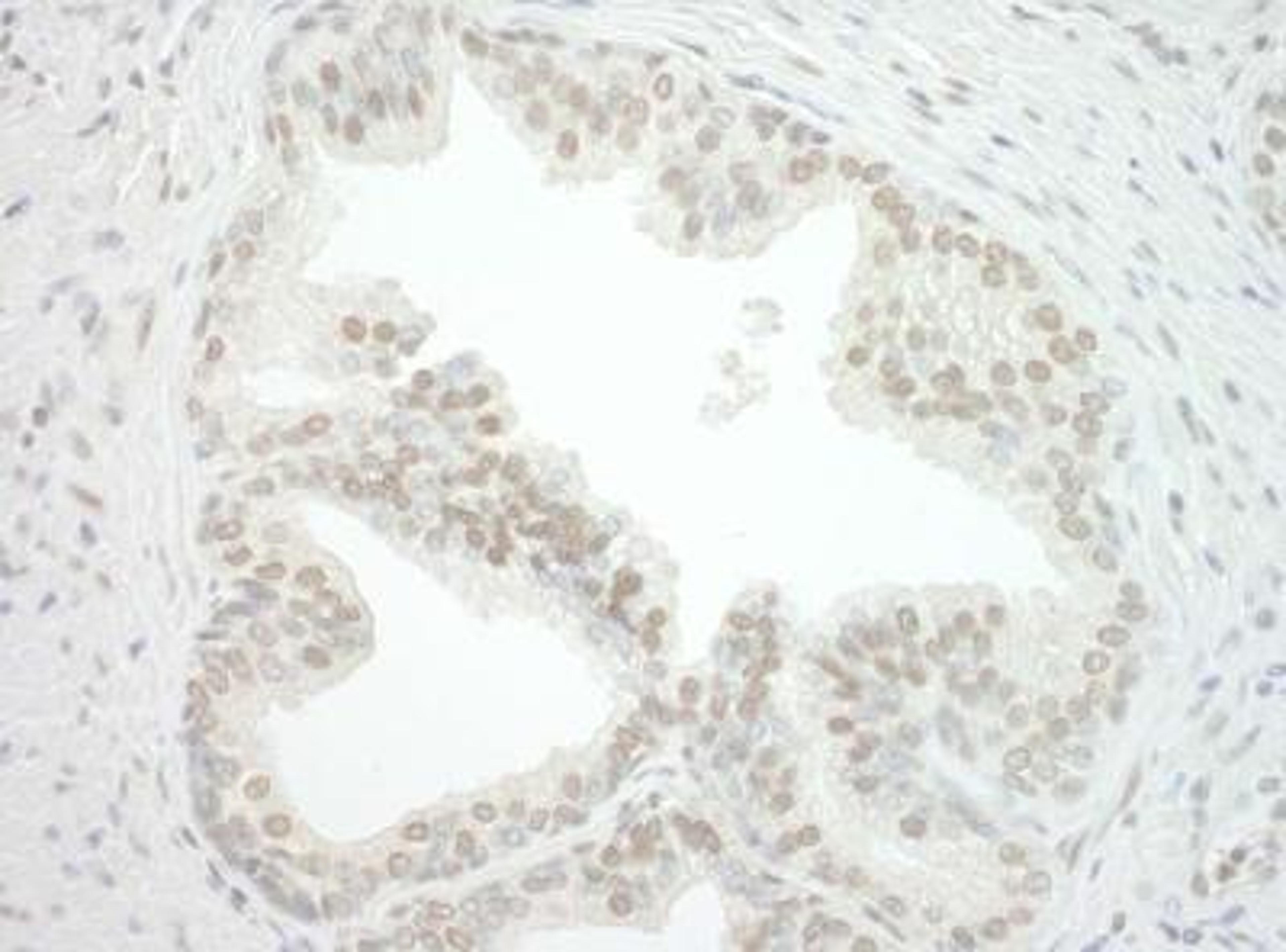 Immunohistochemistry: CBX7 Antibody [NBP1-40343] - FFPE section of human prostate carcinoma.  Antibody used at a dilution of 1:250 Detection: DAB staining using Immunohistochemistry Accessory Kit.