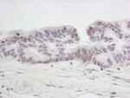 Immunohistochemistry-Paraffin: SMC6L1 Antibody [NB100-470] - FFPE section of human ovarian tumor.  Antibody: Affinity purified rabbit anti-SMC6 used at a dilution of 1:250.  Detection: DAB staining using Immunohistochemistry Accessory Kit