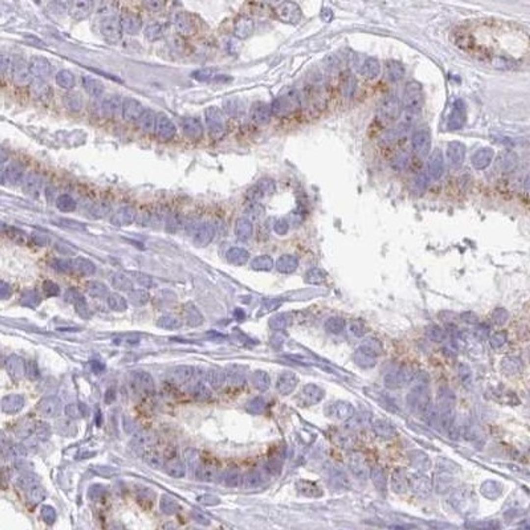 Immunohistochemistry: GLB1L2 Antibody [NBP2-31585] - prostate cancer