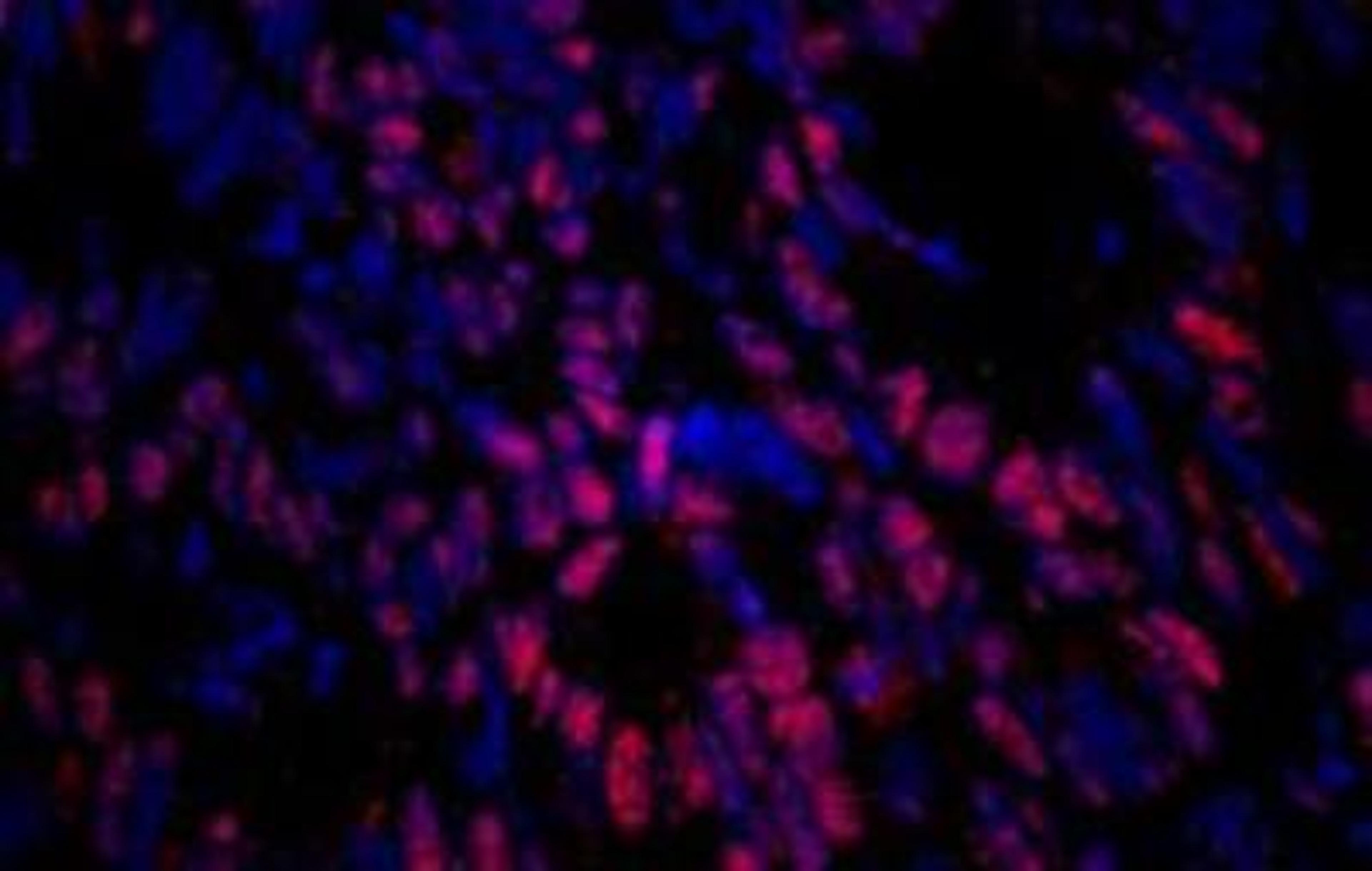 Immunocytochemistry/Immunofluorescence: EZH2/KMT6 [p Ser21] Antibody [NBP1-18935] - FFPE section of human colon carcinoma. 88) used at a dilution of 1:100.