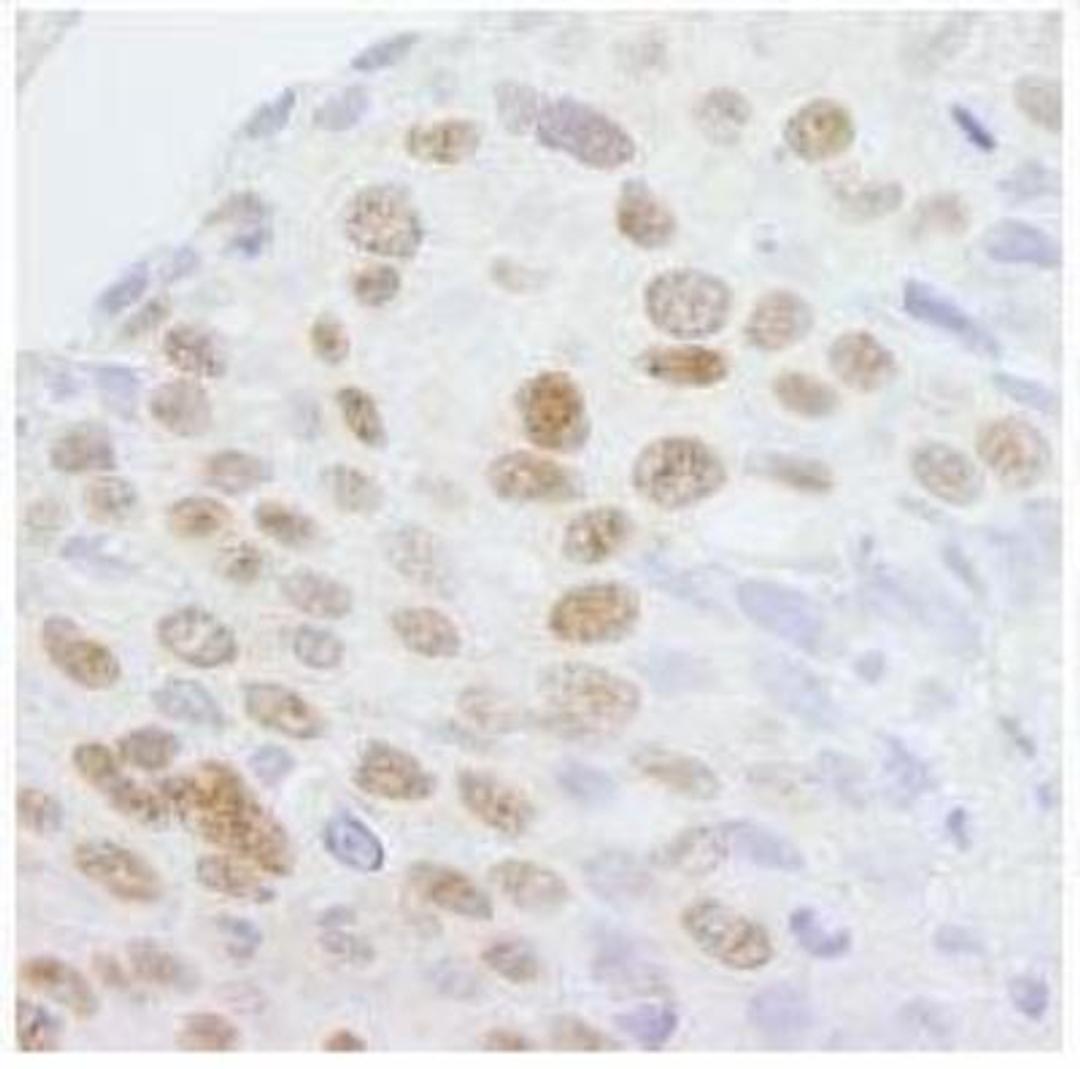 Immunohistochemistry-Paraffin: ZCCHC8 Antibody [NB100-94995] - Section of human breast carcinoma. Antibody: Affinity purified rabbit anti-ZCCHC8 at a dilution of 1:250.