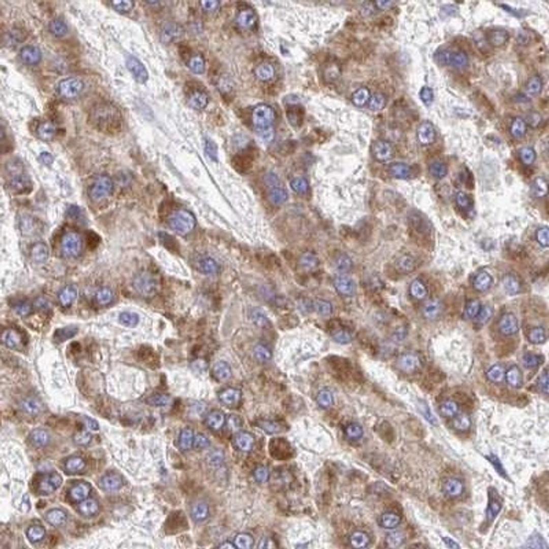 Immunohistochemistry: BRP44 Antibody [NBP2-31623] - liver cancer