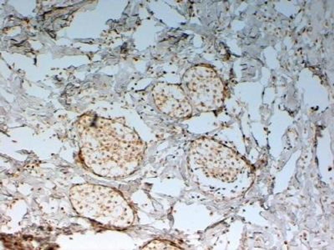 Immunohistochemistry-Paraffin: FoxC2 Antibody [NB100-1269] - FOXC2 Antibody [NB100-1269] - (2ug/ml) staining of paraffin embedded Human Breast cancer. Steamed antigen retrieval with citrate buffer pH 6, HRP-staining.