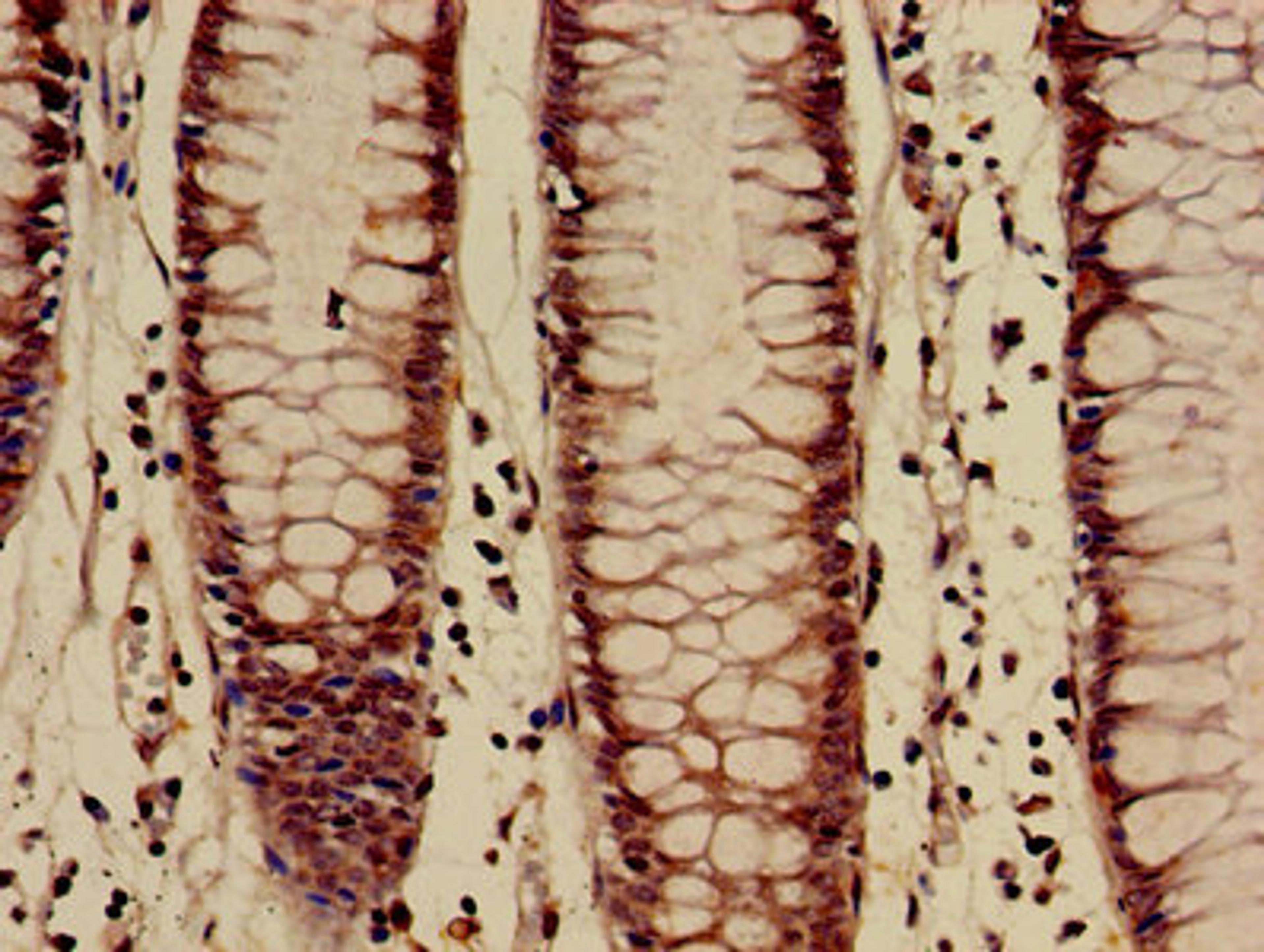 Immunohistochemistry of paraffin-embedded human colon cancer using CSB-PA010418OA27nme2HU at dilution of 1:100