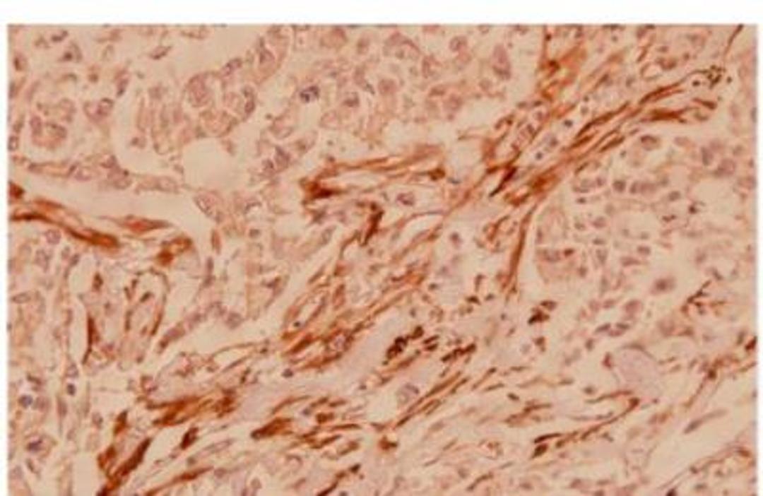 Immunohistochemistry-Paraffin: actin, gamma 2 Antibody [NB100-91649] - Analysis in paraffin-embedded human breast carinoma tissue at 1:100