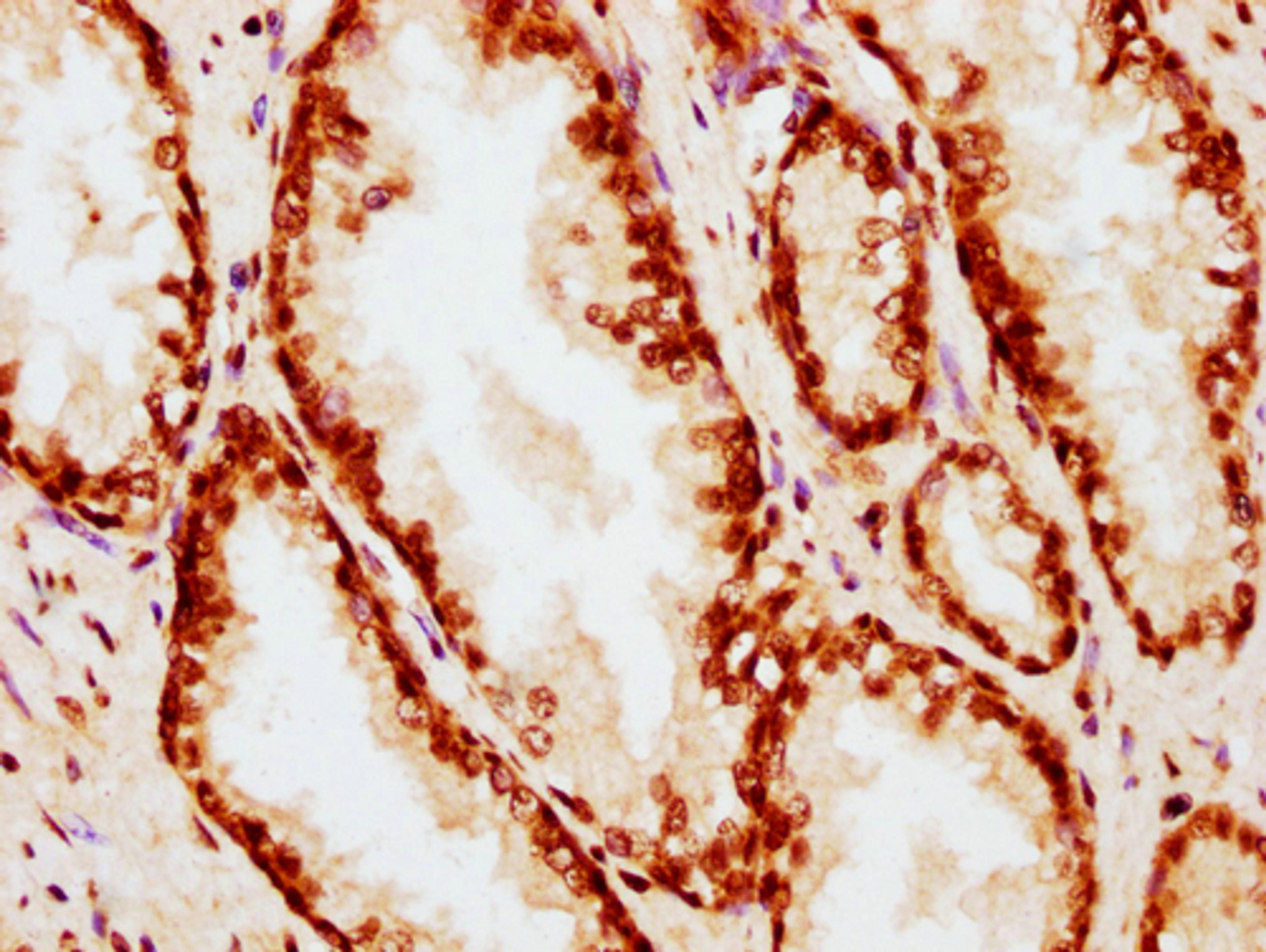 IHC image of CSB-PA010380OA35nphHU diluted at 1:20 and staining in paraffin-embedded human prostate cancer performed on a Leica BondTM system. After dewaxing and hydration, antigen retrieval was mediated by high pressure in a citrate buffer (pH 6.0). Section was blocked with 10% normal goat serum 30min at RT. Then primary antibody (1% BSA) was incubated at 4°C overnight. The primary is detected by a biotinylated secondary antibody and visualized using an HRP conjugated SP system.