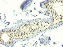 Formalin-fixed, paraffin-embedded human testicular carcinoma stained with Thymidylate Synthase antibody (TS106).