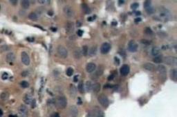 Immunohistochemistry-Paraffin: p21/CIP1/CDKN1A Antibody [NB100-92599] - Paraffin-embedded human breast  carcinoma tissue.