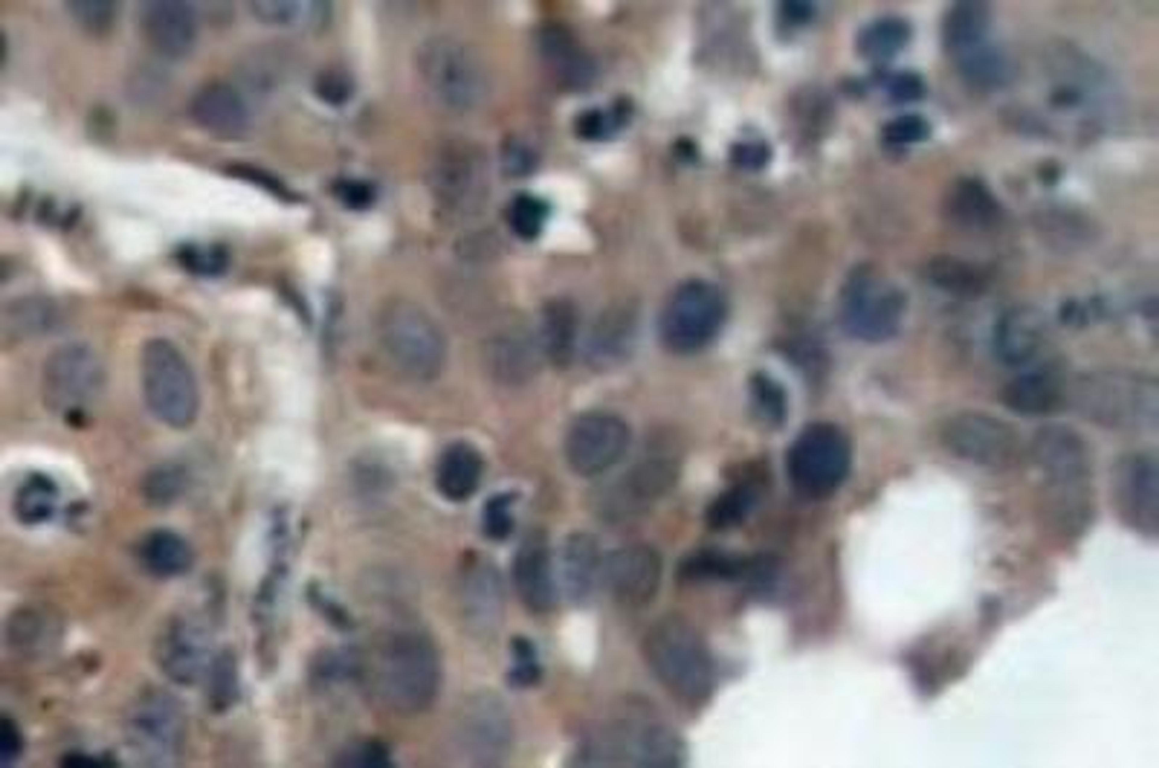 Immunohistochemistry-Paraffin: p21/CIP1/CDKN1A Antibody [NB100-92599] - Paraffin-embedded human breast  carcinoma tissue.