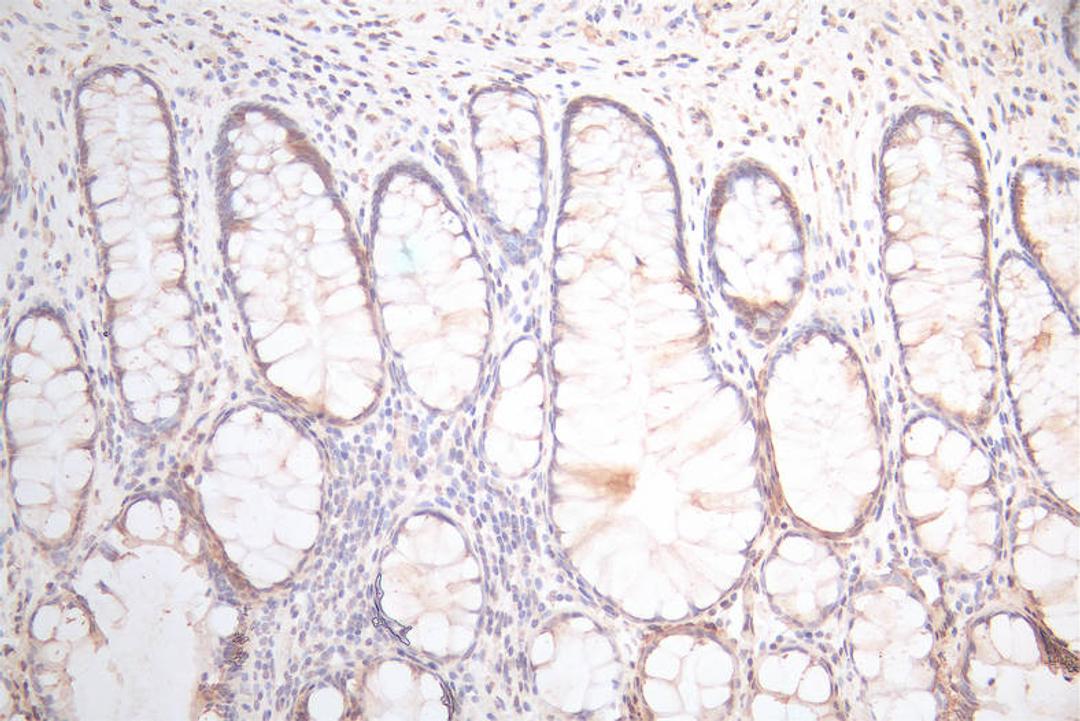 IHC image of CSB-RA025440MA1HU diluted at 1:300 and staining in paraffin-embedded human colorectal cancer performed on a Leica BondTM system. After dewaxing and hydration,  antigen retrieval was mediated by high pressure in a citrate buffer (pH 6.0). Section was blocked with 10% normal goat serum 30min at RT. Then primary antibody (1% BSA) was incubated at 4°C overnight. The primary is detected by a Goat anti-Mouse IgG labeled by HRP and visualized using 0.05% DAB.