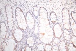 IHC image of CSB-RA025440MA1HU diluted at 1:300 and staining in paraffin-embedded human colorectal cancer performed on a Leica BondTM system. After dewaxing and hydration,  antigen retrieval was mediated by high pressure in a citrate buffer (pH 6.0). Section was blocked with 10% normal goat serum 30min at RT. Then primary antibody (1% BSA) was incubated at 4°C overnight. The primary is detected by a Goat anti-Mouse IgG labeled by HRP and visualized using 0.05% DAB.