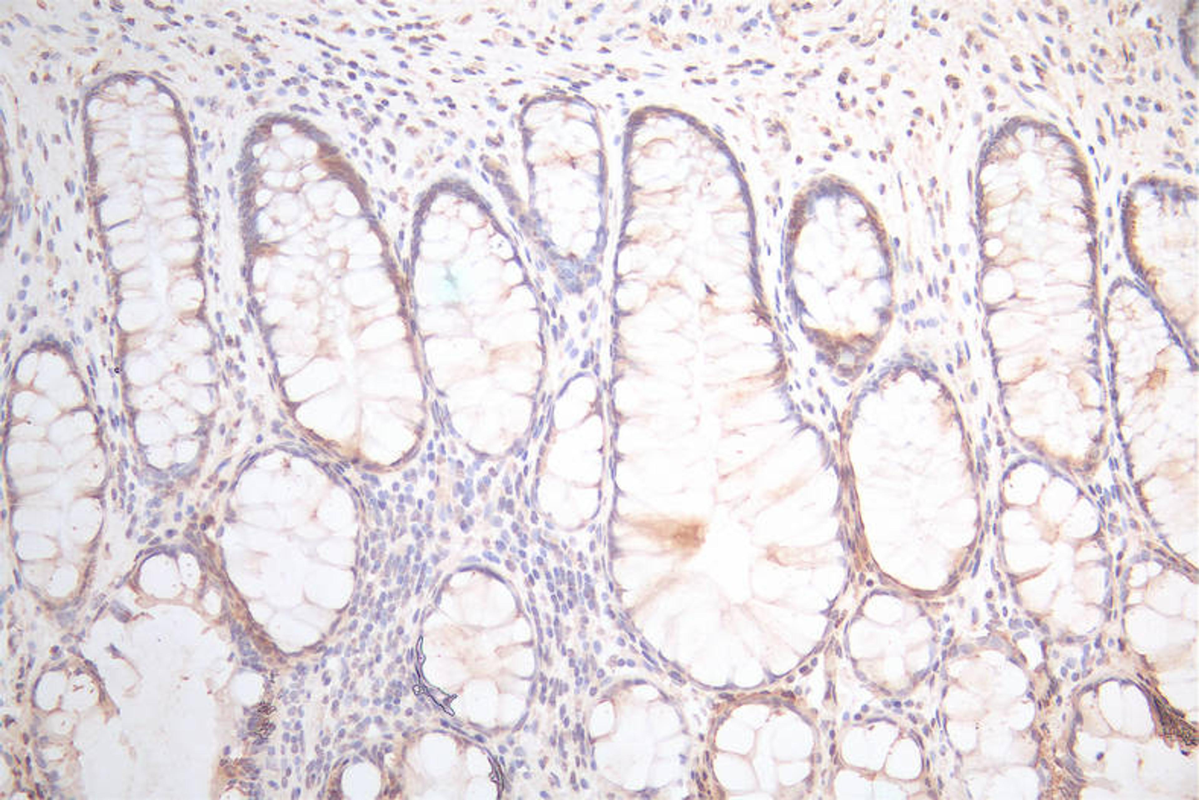 IHC image of CSB-RA025440MA1HU diluted at 1:300 and staining in paraffin-embedded human colorectal cancer performed on a Leica BondTM system. After dewaxing and hydration,  antigen retrieval was mediated by high pressure in a citrate buffer (pH 6.0). Section was blocked with 10% normal goat serum 30min at RT. Then primary antibody (1% BSA) was incubated at 4°C overnight. The primary is detected by a Goat anti-Mouse IgG labeled by HRP and visualized using 0.05% DAB.