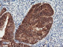 Immunohistochemistry-Paraffin: PSMA4 Antibody (4B8) [NBP2-01608] - Staining of paraffin-embedded Adenocarcinoma of Human endometrium tissue using anti-PSMA4 mouse monoclonal antibody.