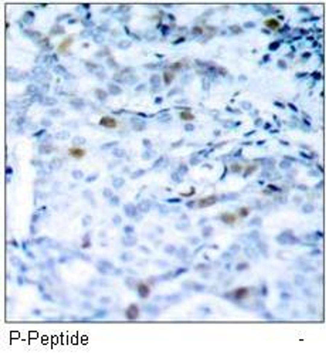 Immunohistochemical analysis of paraffin-embedded human breast carcinoma tissue, using CDC2 (phospho-Thr161) antibody