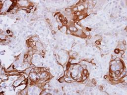 Immunohistochemistry-Paraffin: 67kDa Laminin Receptor Antibody [NBP1-33002] - Paraffin-embedded CA922 xenograft, using antibody at 1:500 dilution.