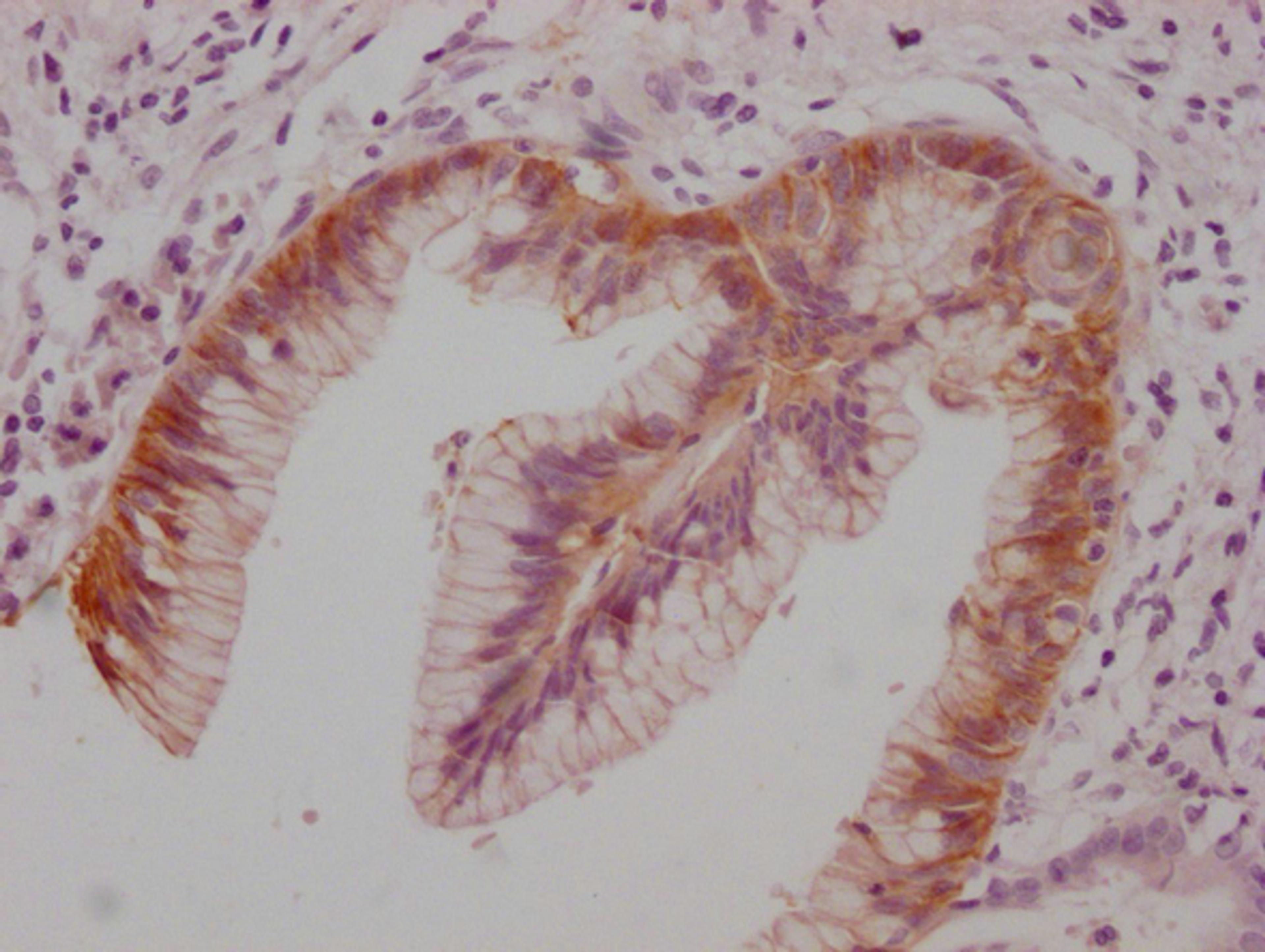 IHC image of CSB-MA148581 diluted at 1:100 and staining in paraffin-embedded human pancreatic cancer performed on a Leica BondTM system. After dewaxing and hydration, antigen retrieval was mediated by high pressure in a citrate buffer (pH 6.0). Section was blocked with 10% normal goat serum 30min at RT. Then primary antibody (1% BSA) was incubated at 4°C overnight. The primary is detected by a Goat anti-mouse IgG polymer labeled by HRP and visualized using 0.05% DAB.