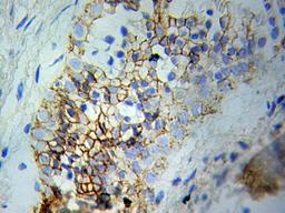 Immunohistochemical analysis of formalin fixed and paraffin-embedded Prostate cancer tissue using ERK2 antibody 