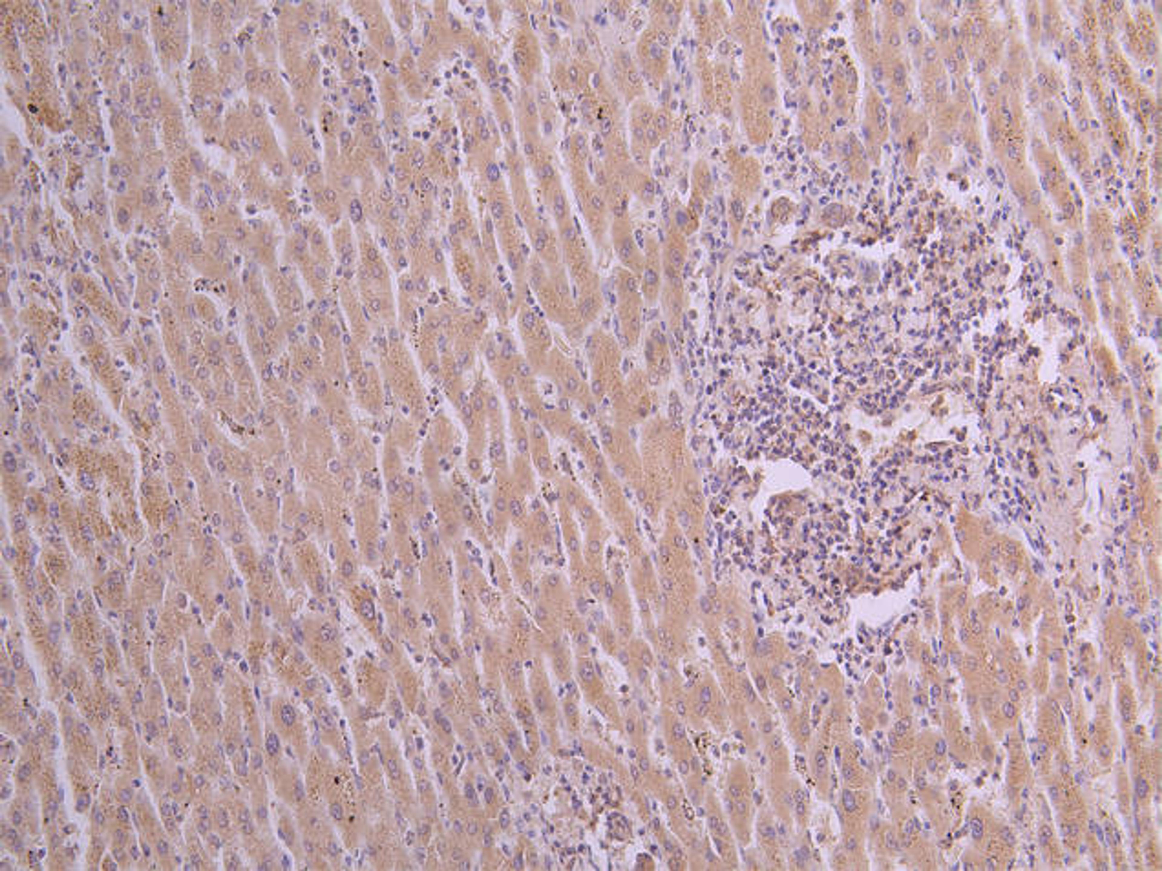 IHC image of CSB-RA025833MA1HU diluted at 1:50 and staining in paraffin-embedded human liver cancer performed on a Leica BondTM system. After dewaxing and hydration, antigen retrieval was mediated by high pressure in a citrate buffer (pH 6.0). Section was blocked with 10% normal goat serum 30min at RT. Then primary antibody (1% BSA) was incubated at 4°C overnight. The primary is detected by a Goat anti-human polymer IgG labeled by HRP and visualized using 0.05% DAB.