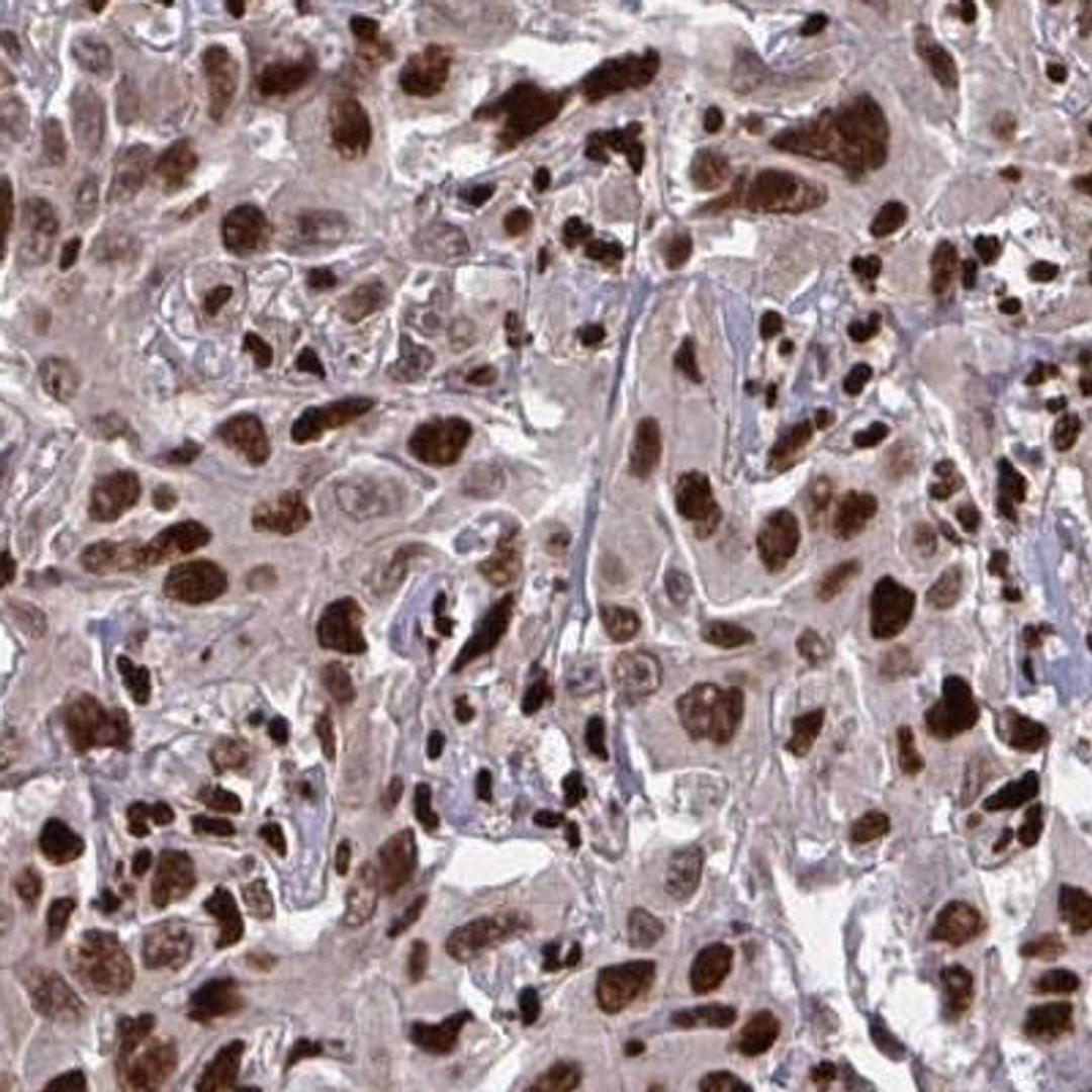 Immunohistochemistry: ZNF559 Antibody [NBP2-31787] - liver cancer