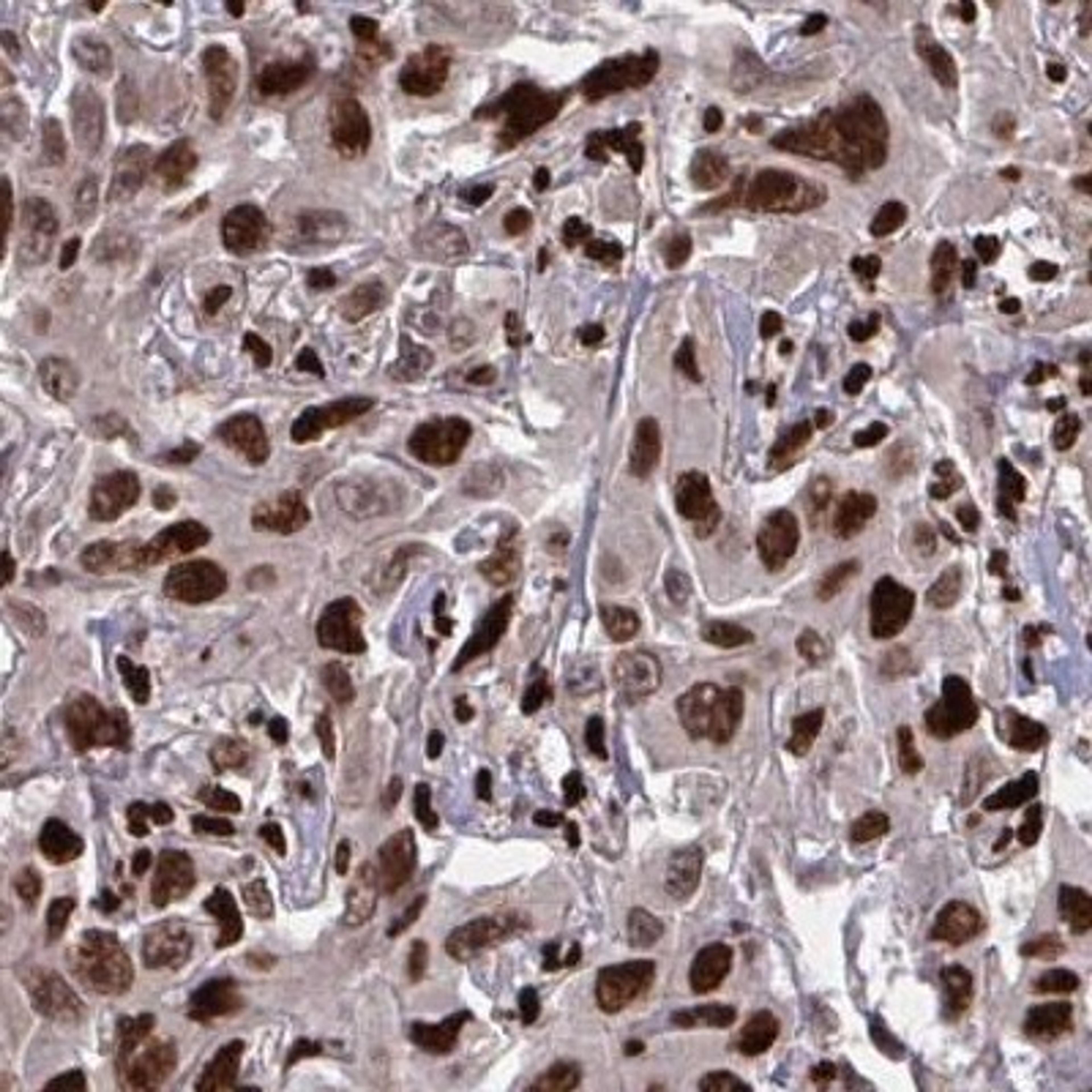 Immunohistochemistry: ZNF559 Antibody [NBP2-31787] - liver cancer