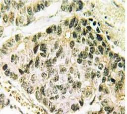 Immunohistochemistry-Paraffin: SNAIL [p Ser246] Antibody [NBP1-51411] - Human lung carcinoma tissue.