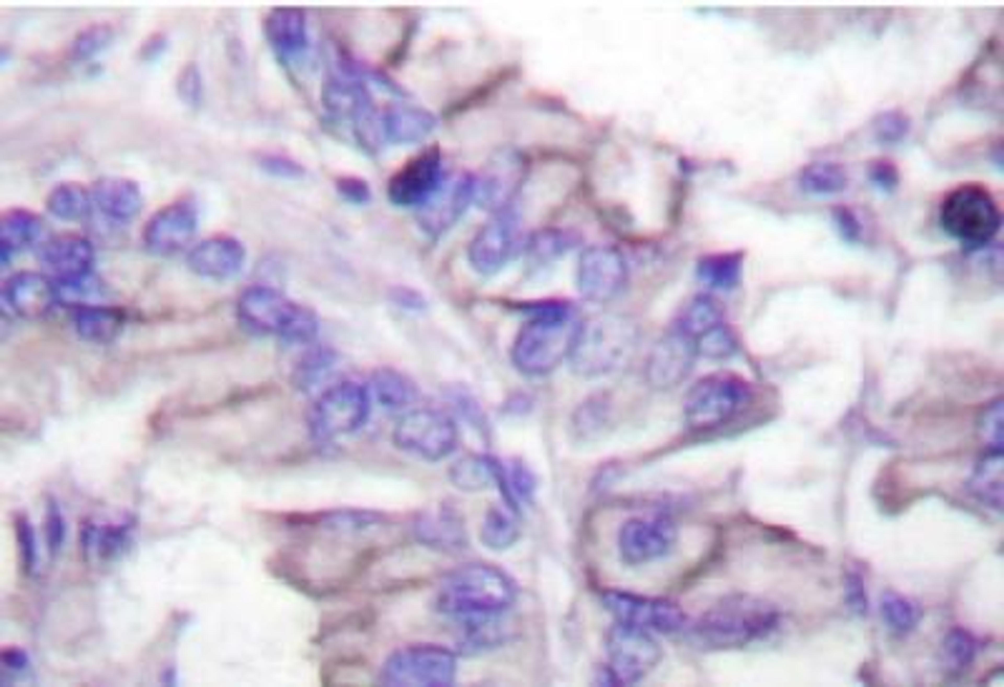 Immunohistochemistry: GAD65/67 Antibody [NB100-92033] - Immunohistochemistry (IHC) analyzes of GAD65/67 (D572) antibody in paraffin-embedded human lung  carcinoma tissue