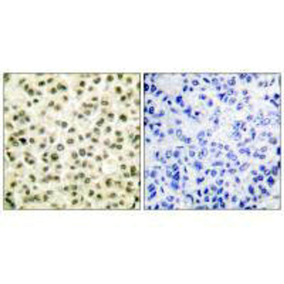 Immunohistochemical analysis of paraffin-embedded human breast carcinoma tissue using Ku70/80 antibody.