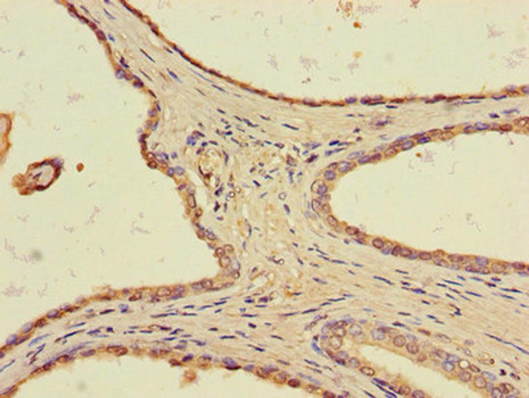 Immunohistochemistry of paraffin-embedded human prostate cancer using CSB-PA023595LA01HU at dilution of 1:100