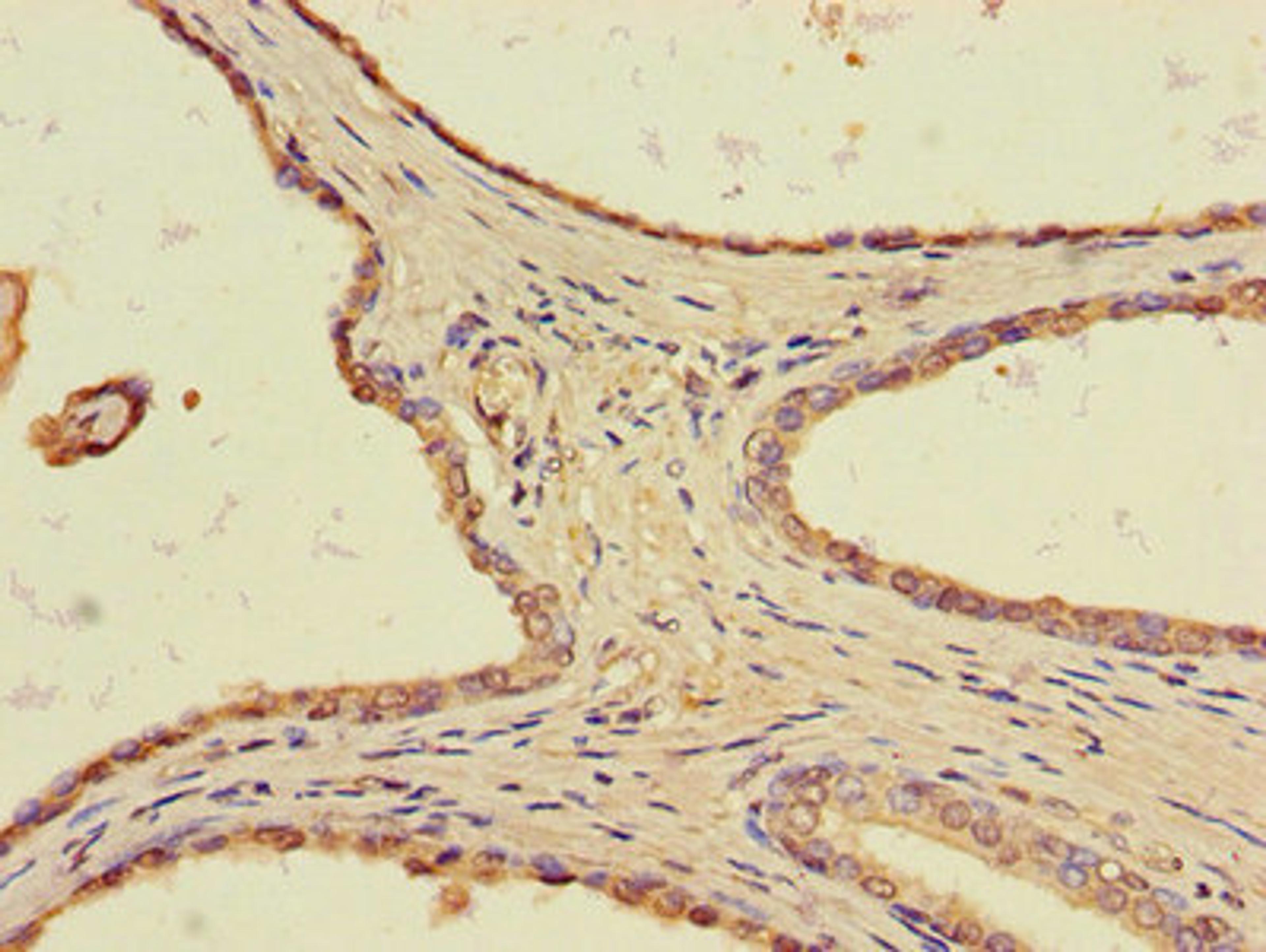 Immunohistochemistry of paraffin-embedded human prostate cancer using CSB-PA023595LA01HU at dilution of 1:100