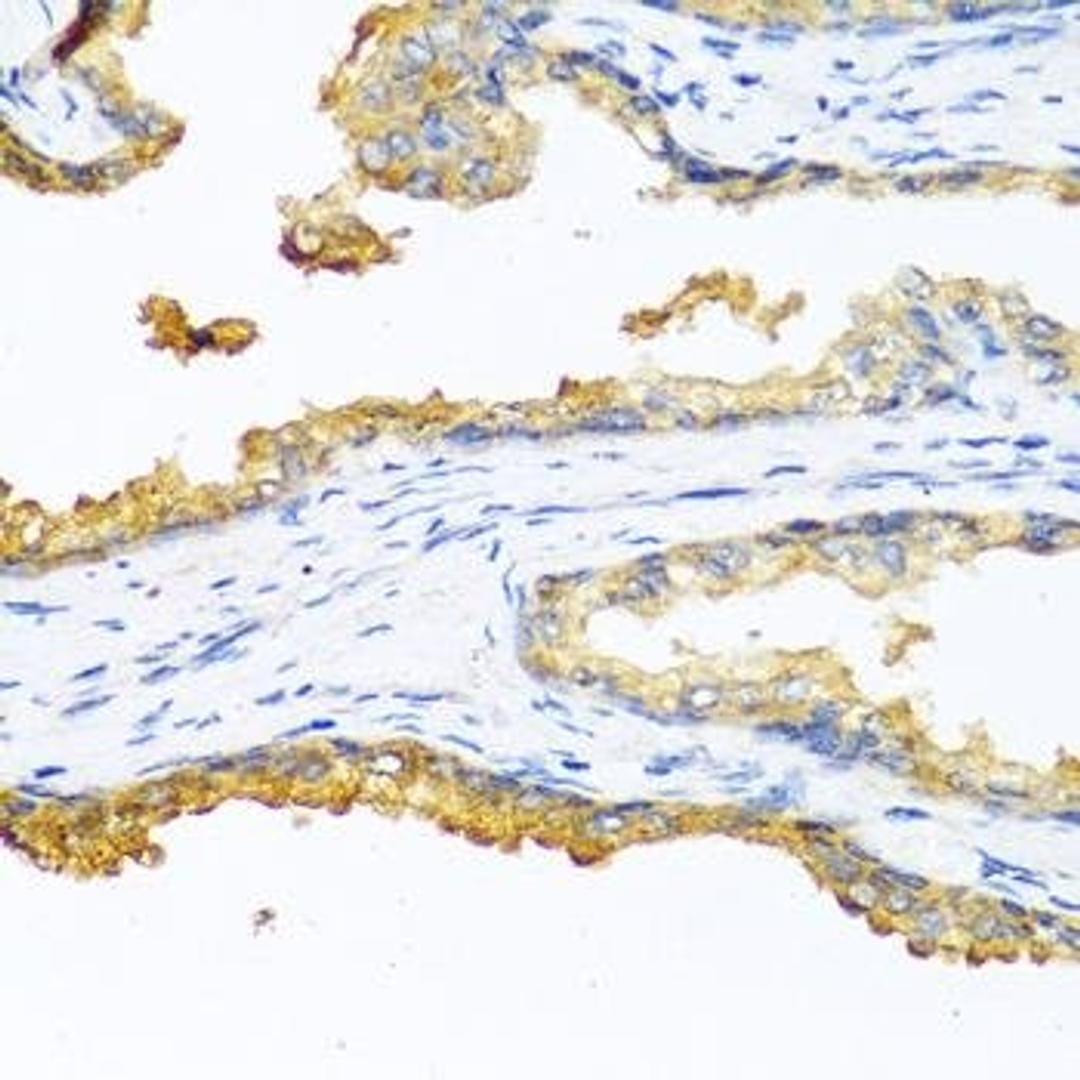 Immunohistochemical staining of human prostate cancer tissue using CPB2 antibody (dilution of 1:100)