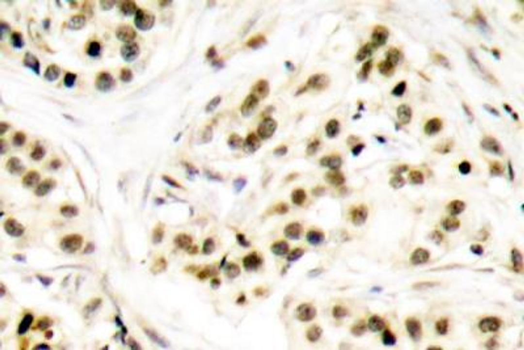 Immunohistochemistry-Paraffin: p-Chk2 [p Thr68] Antibody [NB100-92502] - Paraffin-embedded human breast carcinoma tissue.