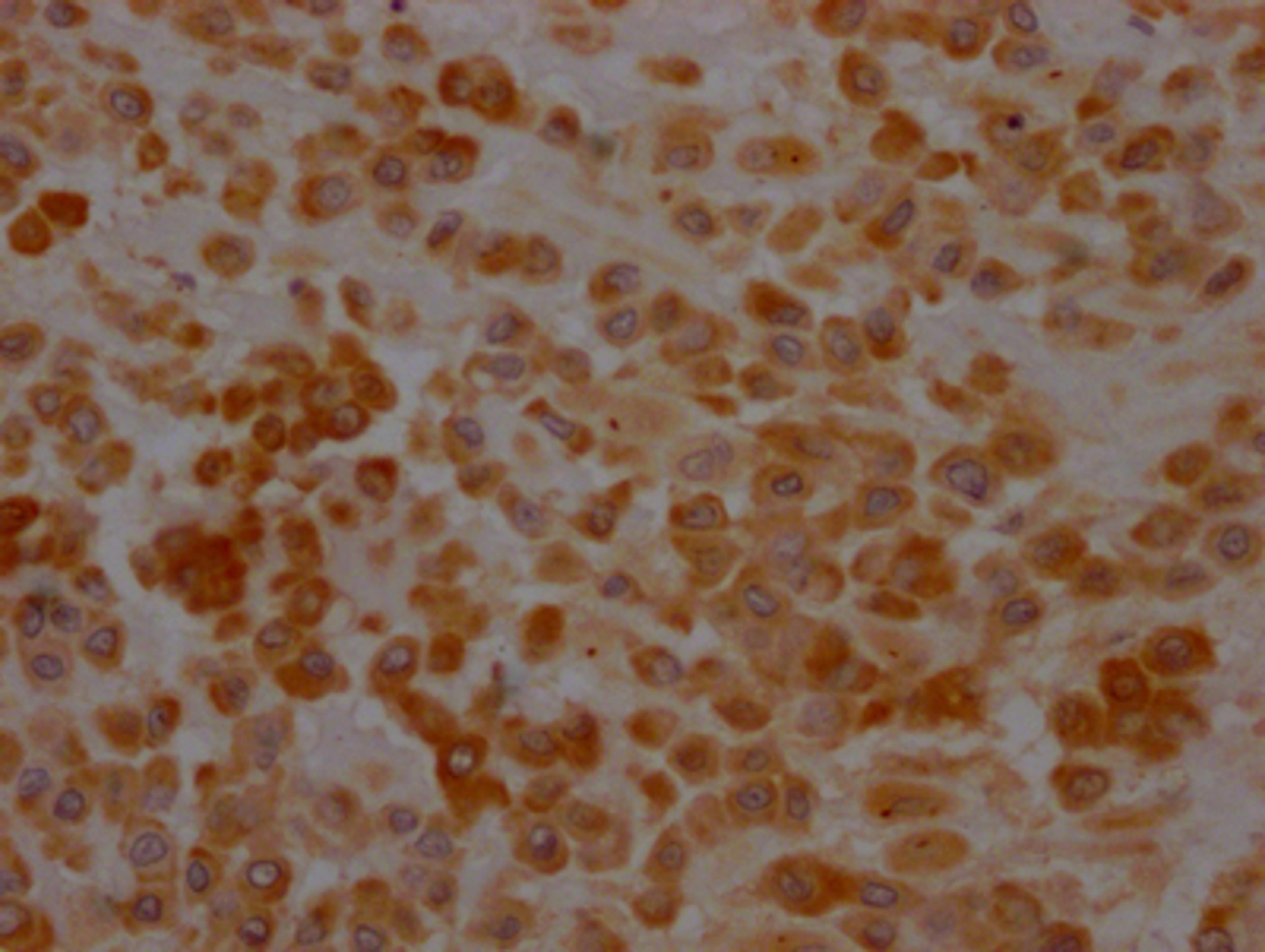 IHC image of CSB-RA699016A0HU diluted at 1:100 and staining in paraffin-embedded human placenta tissue performed on a Leica BondTM system. After dewaxing and hydration, antigen retrieval was mediated by high pressure in a citrate buffer (pH 6.0). Section was blocked with 10% normal goat serum 30min at RT. Then primary antibody (1% BSA) was incubated at 4℃ overnight. The primary is detected by a Goat anti-rabbit IgG polymer labeled by HRP and visualized using 0.05% DAB.