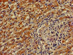 Immunohistochemistry of paraffin-embedded human liver cancer using CSB-PA856900LA01HU at dilution of 1:100