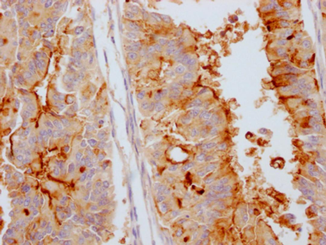 IHC image of CSB-RA973154A0HU diluted at 1:100 and staining in paraffin-embedded human endometrial cancer performed on a Leica BondTM system. After dewaxing and hydration, antigen retrieval was mediated by high pressure in a citrate buffer (pH 6.0). Section was blocked with 10% normal goat serum 30min at RT. Then primary antibody (1% BSA) was incubated at 4℃ overnight. The primary is detected by a Goat anti-rabbit IgG polymer labeled by HRP and visualized using 0.05% DAB.