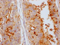 IHC image of CSB-RA973154A0HU diluted at 1:100 and staining in paraffin-embedded human endometrial cancer performed on a Leica BondTM system. After dewaxing and hydration, antigen retrieval was mediated by high pressure in a citrate buffer (pH 6.0). Section was blocked with 10% normal goat serum 30min at RT. Then primary antibody (1% BSA) was incubated at 4℃ overnight. The primary is detected by a Goat anti-rabbit IgG polymer labeled by HRP and visualized using 0.05% DAB.
