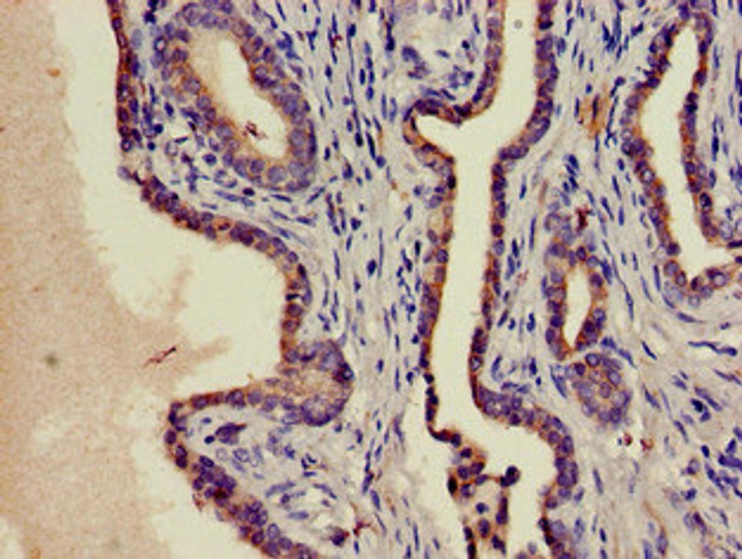 Immunohistochemistry of paraffin-embedded human prostate cancer using CSB-PA02959A0Rb at dilution of 1:100