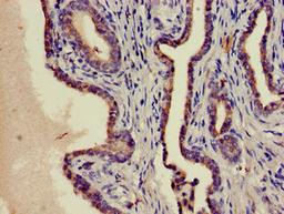 Immunohistochemistry of paraffin-embedded human prostate cancer using CSB-PA02959A0Rb at dilution of 1:100