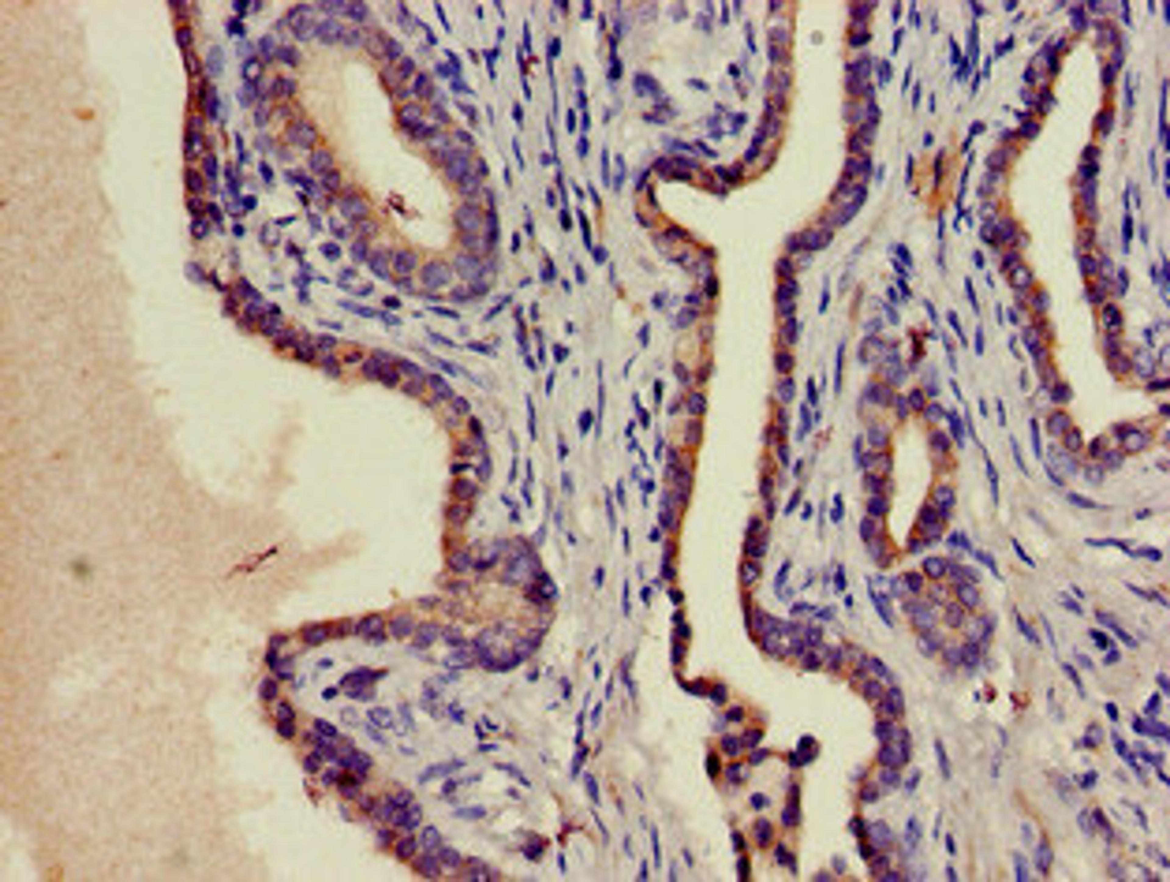 Immunohistochemistry of paraffin-embedded human prostate cancer using CSB-PA02959A0Rb at dilution of 1:100