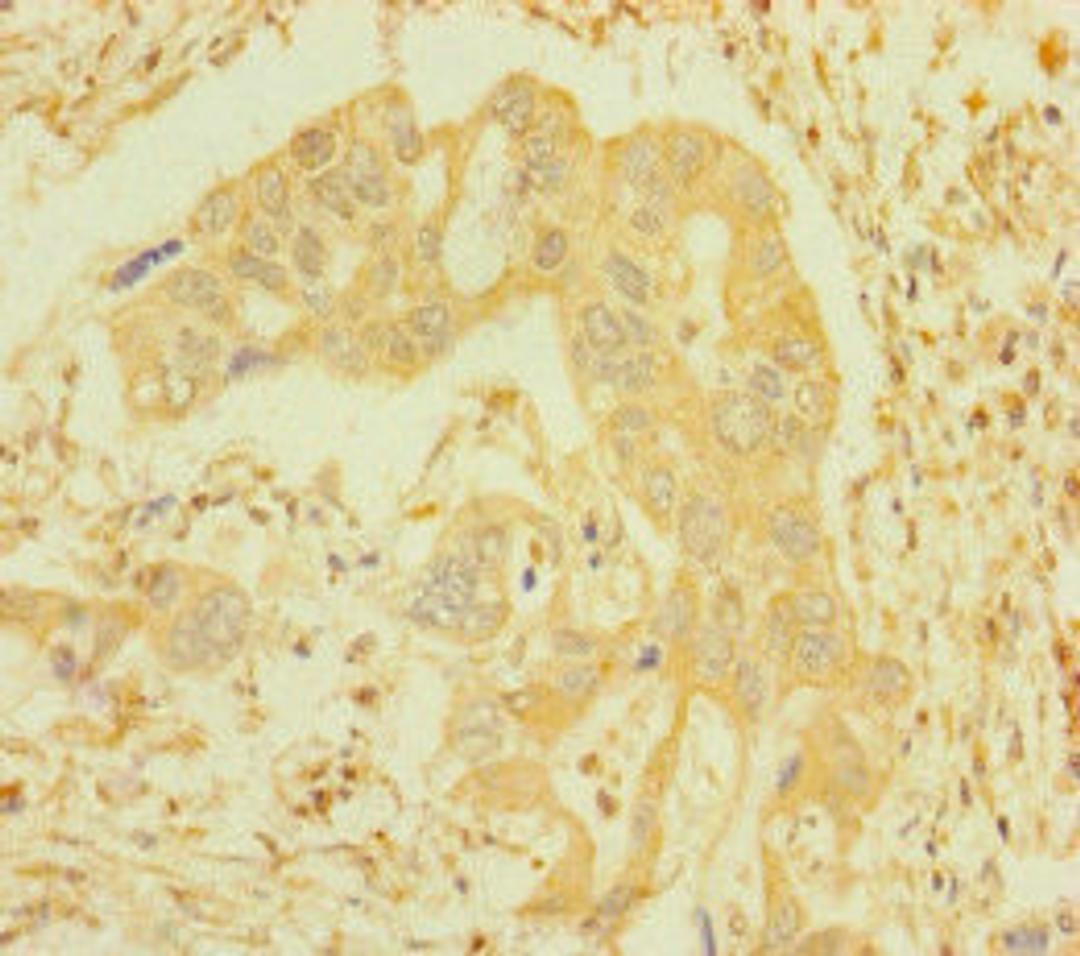 Immunohistochemistry of paraffin-embedded human pancreatic cancer using CSB-PA011028HA01HU at dilution of 1:100