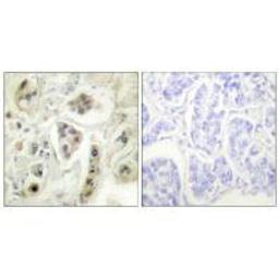 Immunohistochemical analysis of paraffin-embedded human lung carcinoma tissue using HSP60 antibody.