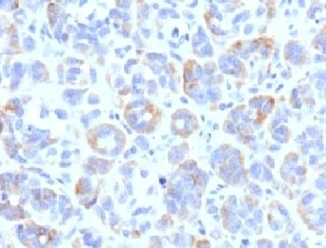 IHC testing of FFPE human melanoma with TRP1 antibody (clone TYRR1-1)