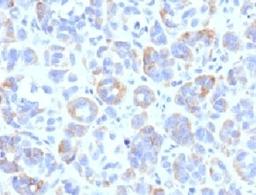 IHC testing of FFPE human melanoma with TRP1 antibody (clone TYRR1-1)