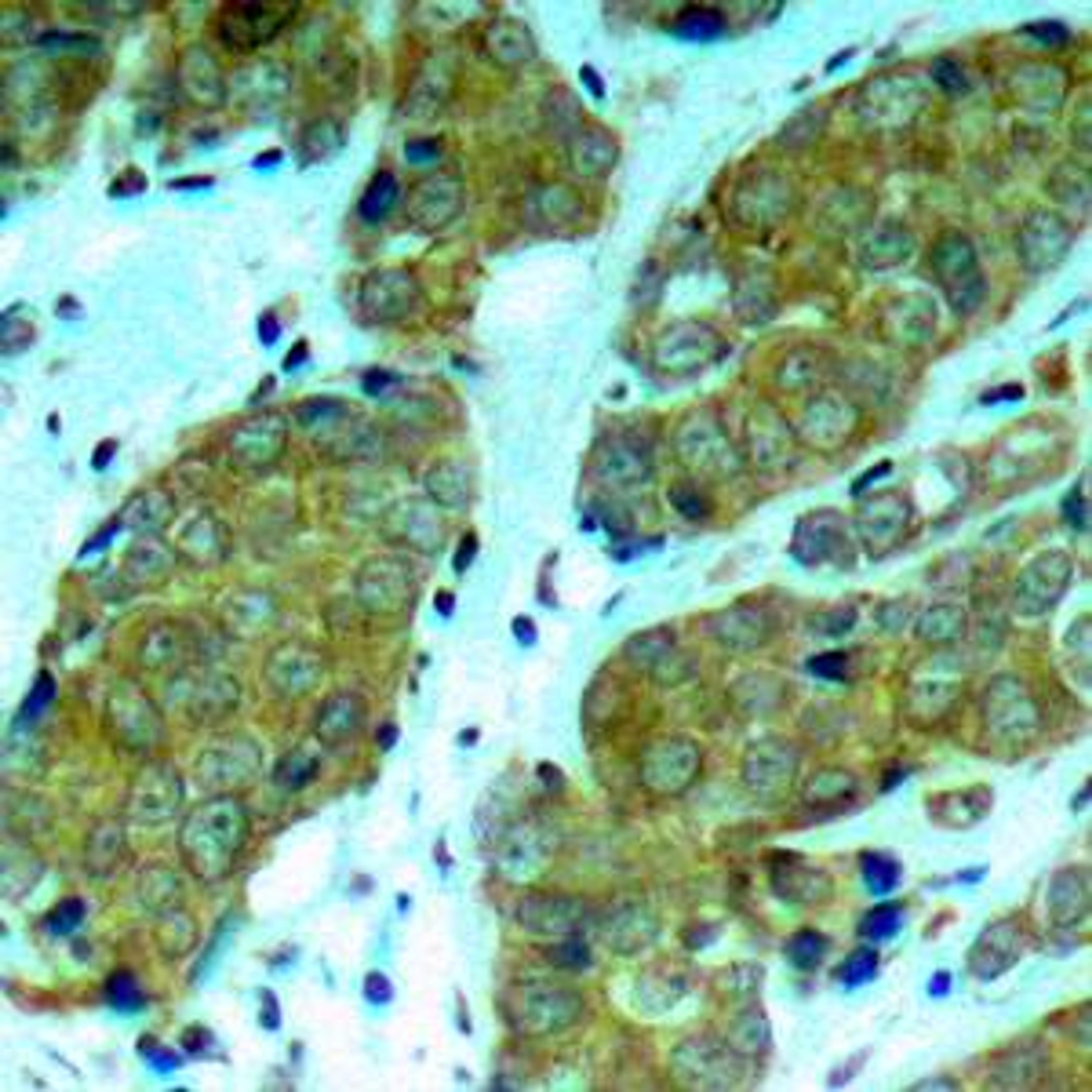 Immunohistochemical analysis of formalin-fixed and paraffin-embedded human breast carcinoma tissue using mTOR(Phospho-Ser2448) antibody