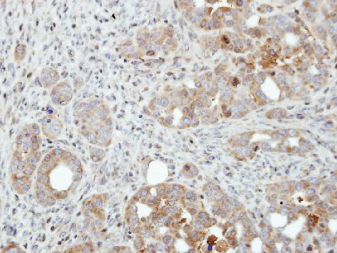 Immunohistochemistry-Paraffin: PFKFB4 Antibody [NBP1-32538] - Paraffin-embedded NCI-N87 xenograft, using antibody at 1:500 dilution.