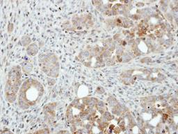 Immunohistochemistry-Paraffin: PFKFB4 Antibody [NBP1-32538] - Paraffin-embedded NCI-N87 xenograft, using antibody at 1:500 dilution.