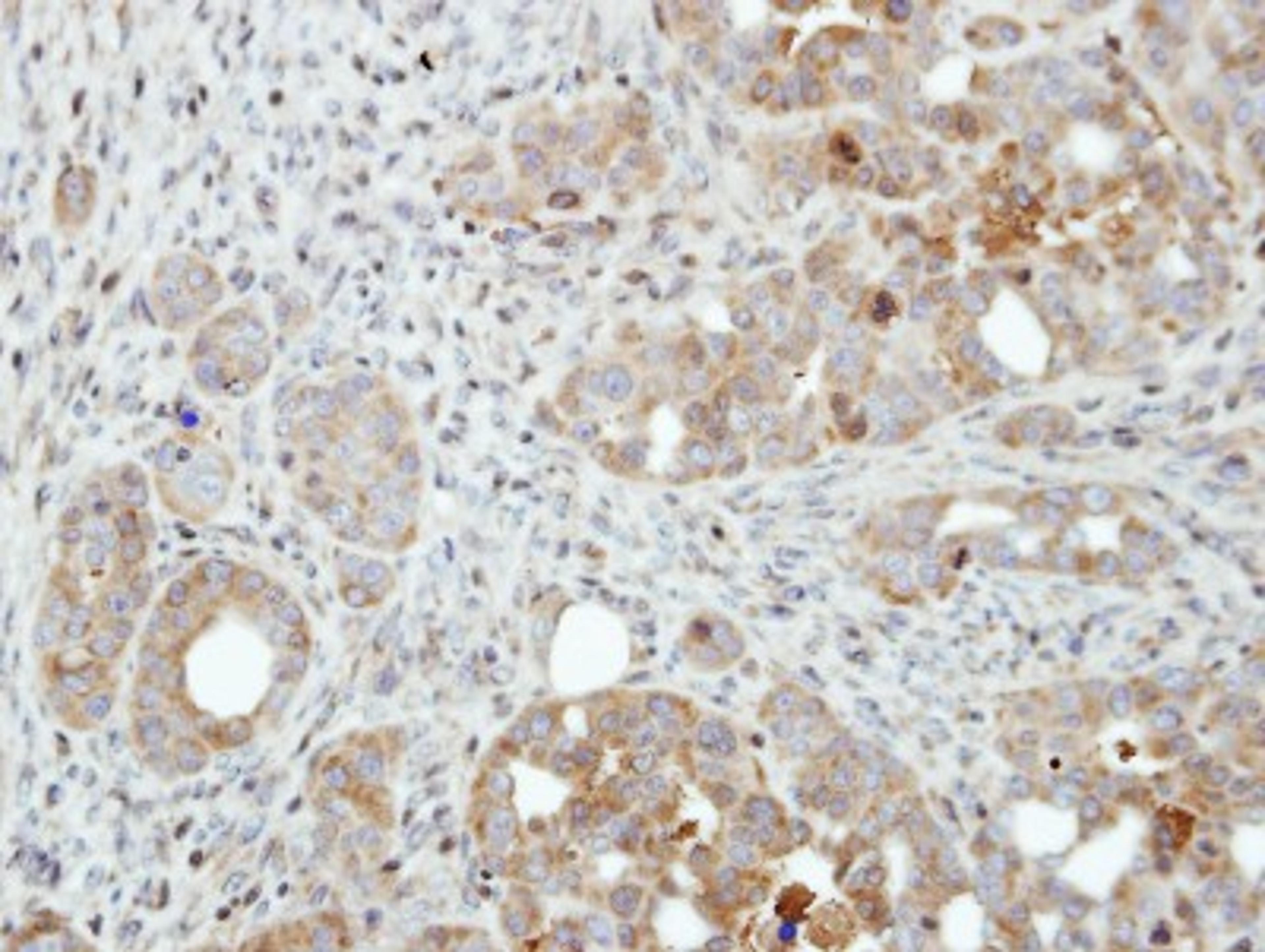 Immunohistochemistry-Paraffin: PFKFB4 Antibody [NBP1-32538] - Paraffin-embedded NCI-N87 xenograft, using antibody at 1:500 dilution.