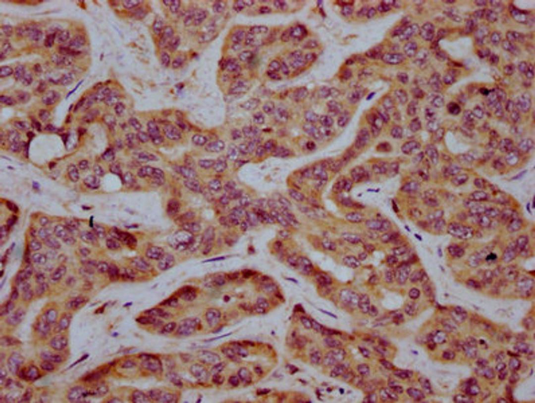 IHC image of CSB-PA015013LA01HU diluted at 1:400 and staining in paraffin-embedded human liver cancer performed on a Leica BondTM system. After dewaxing and hydration, antigen retrieval was mediated by high pressure in a citrate buffer (pH 6.0). Section was blocked with 10% normal goat serum 30min at RT. Then primary antibody (1% BSA) was incubated at 4&deg;C overnight. The primary is detected by a biotinylated secondary antibody and visualized using an HRP conjugated SP system.