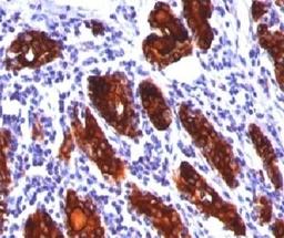 IHC staining of thyroid tissue with Thyroglobulin antibody (2H11, aka clone TBG04).