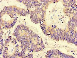 Immunohistochemistry of paraffin-embedded human colon cancer using CSB-PA839338LA01HU at dilution of 1: 100